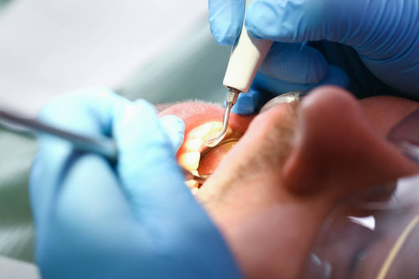Best Emergency Dental Care for Broken or Chipped Teeth in Taylorvle, IL