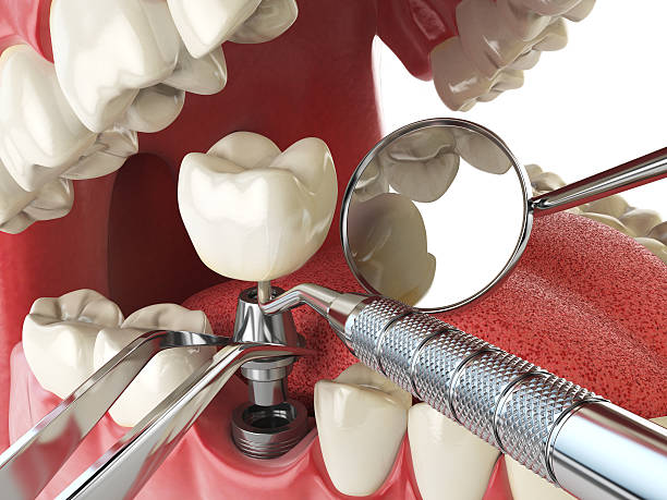Best Emergency Tooth Extraction in Taylorvle, IL